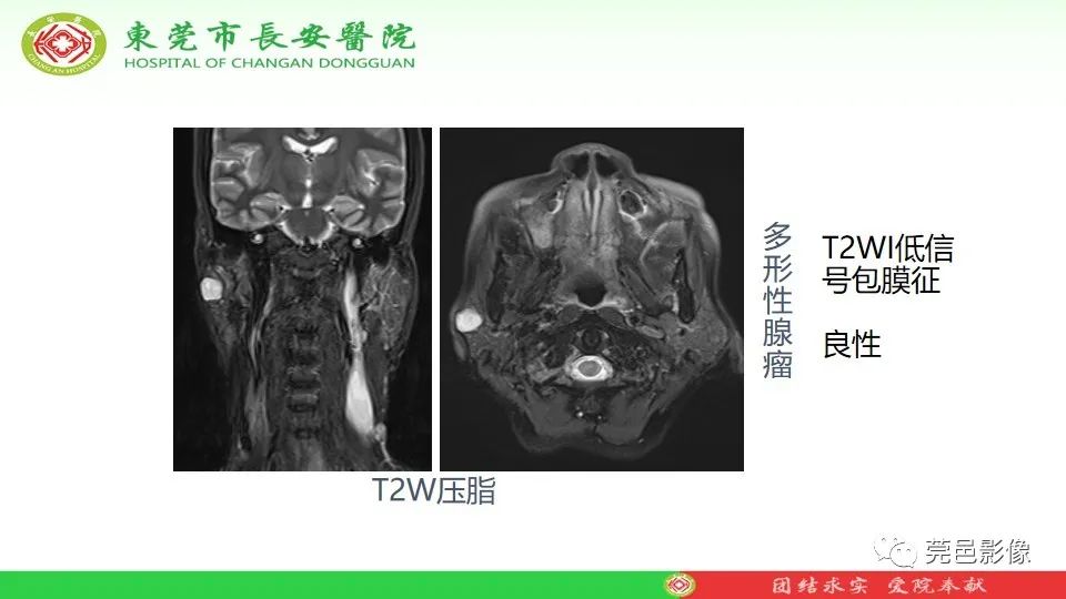 影像PPT - 【PPT】MRI征象在腮腺占位良恶性鉴别中的应用-41