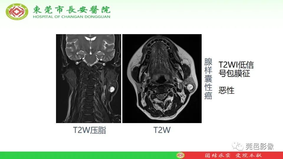 影像PPT - 【PPT】MRI征象在腮腺占位良恶性鉴别中的应用-42