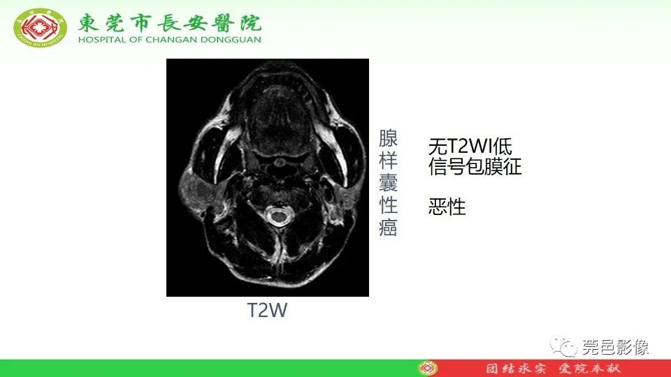 影像PPT - 【PPT】MRI征象在腮腺占位良恶性鉴别中的应用-45
