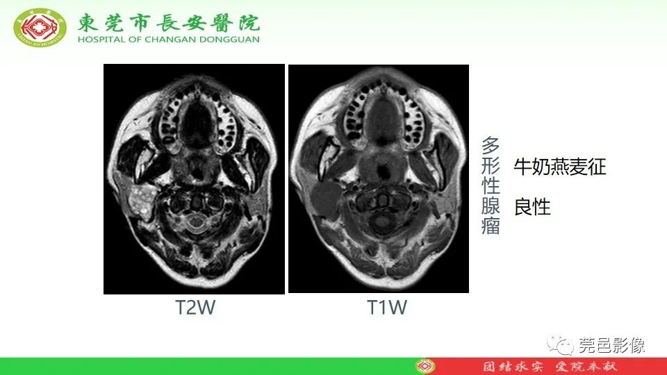 影像PPT - 【PPT】MRI征象在腮腺占位良恶性鉴别中的应用-49