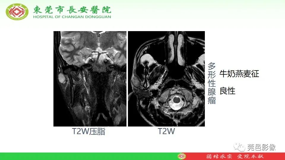 影像PPT - 【PPT】MRI征象在腮腺占位良恶性鉴别中的应用-50
