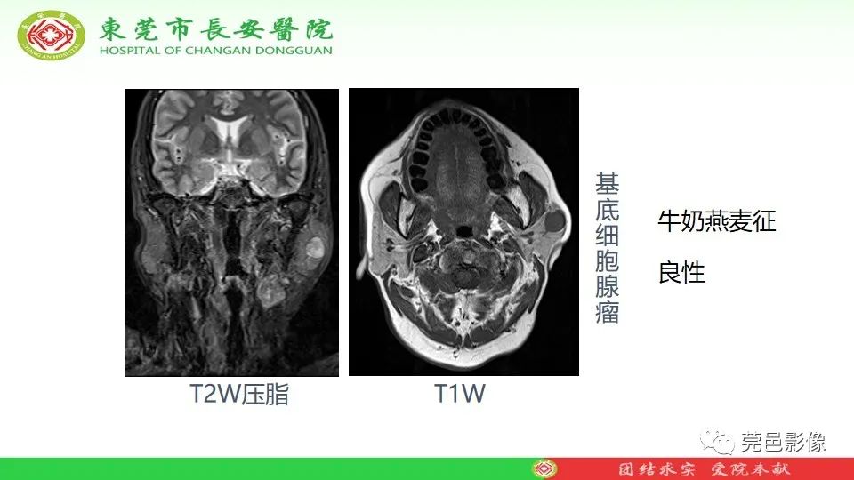 影像PPT - 【PPT】MRI征象在腮腺占位良恶性鉴别中的应用-51