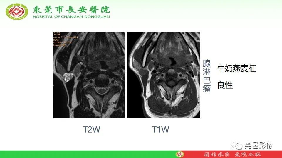 影像PPT - 【PPT】MRI征象在腮腺占位良恶性鉴别中的应用-48