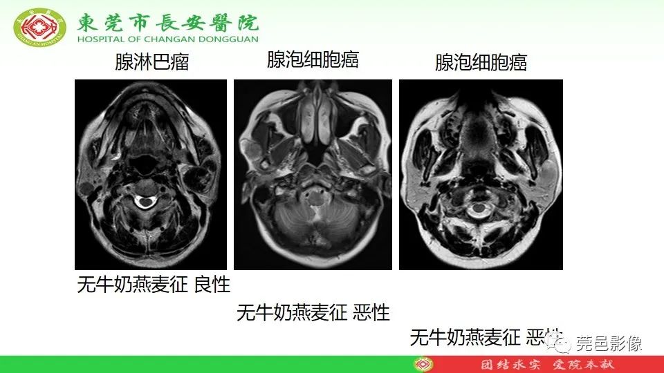 影像PPT - 【PPT】MRI征象在腮腺占位良恶性鉴别中的应用-52