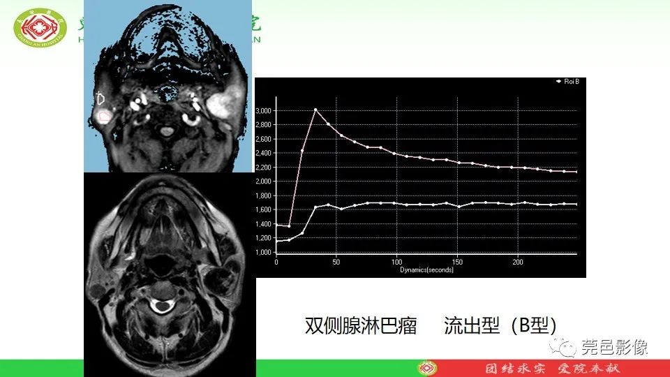 影像PPT - 【PPT】MRI征象在腮腺占位良恶性鉴别中的应用-57