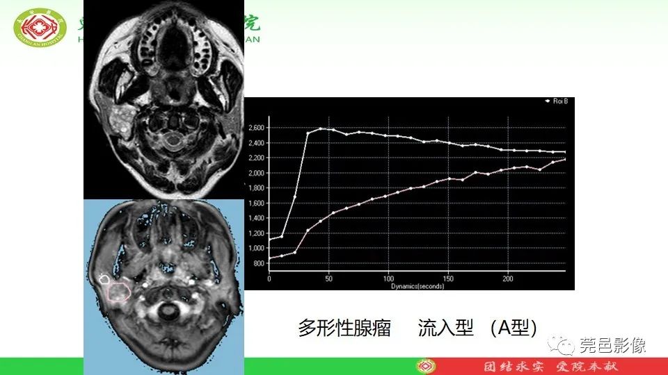 影像PPT - 【PPT】MRI征象在腮腺占位良恶性鉴别中的应用-58