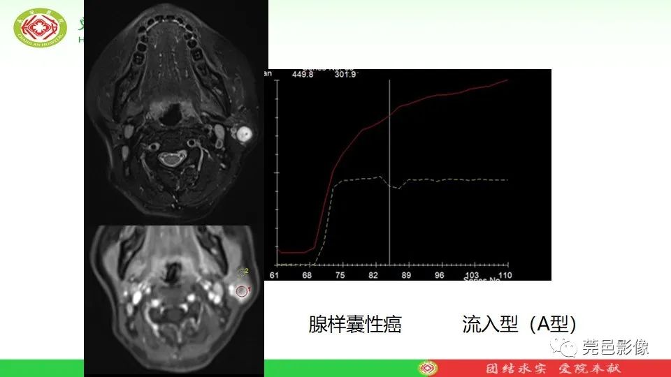 影像PPT - 【PPT】MRI征象在腮腺占位良恶性鉴别中的应用-59