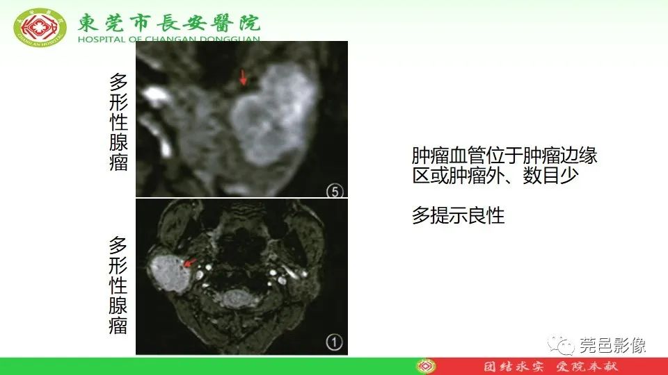 影像PPT - 【PPT】MRI征象在腮腺占位良恶性鉴别中的应用-63