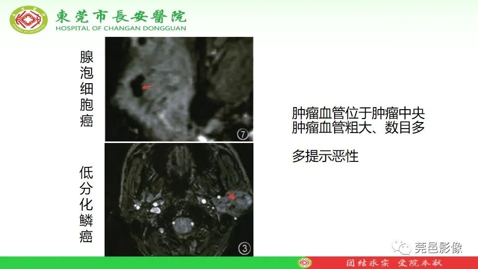 影像PPT - 【PPT】MRI征象在腮腺占位良恶性鉴别中的应用-64
