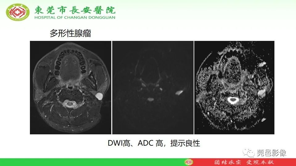 影像PPT - 【PPT】MRI征象在腮腺占位良恶性鉴别中的应用-67