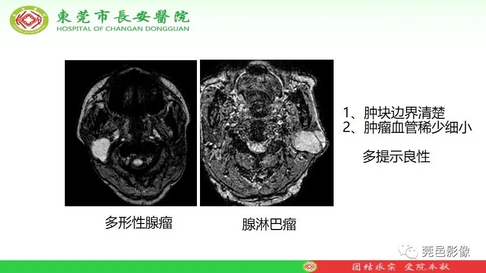 影像PPT - 【PPT】MRI征象在腮腺占位良恶性鉴别中的应用-62