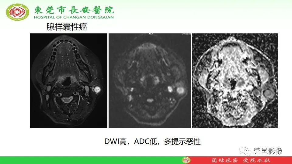 影像PPT - 【PPT】MRI征象在腮腺占位良恶性鉴别中的应用-68