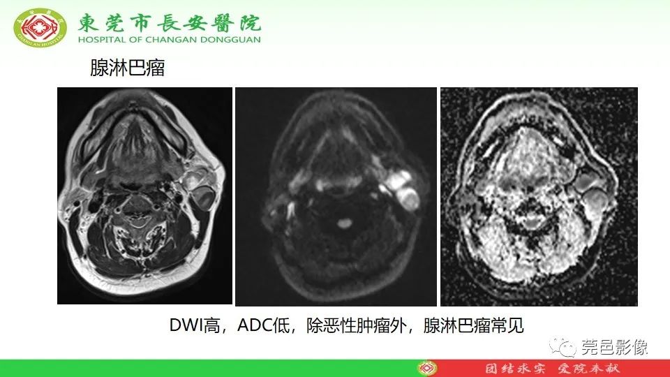 影像PPT - 【PPT】MRI征象在腮腺占位良恶性鉴别中的应用-69