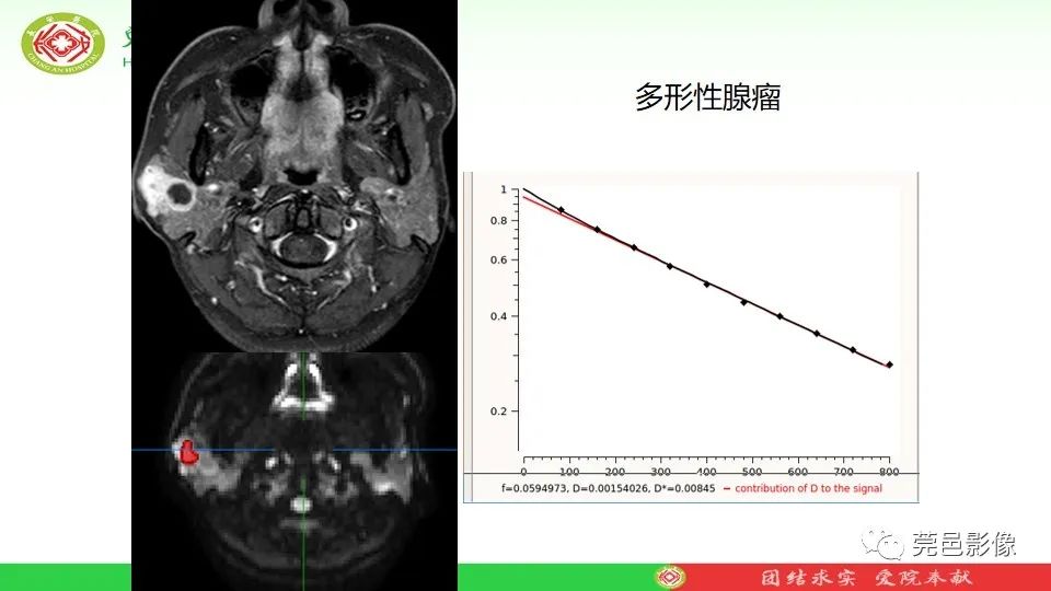 影像PPT - 【PPT】MRI征象在腮腺占位良恶性鉴别中的应用-73