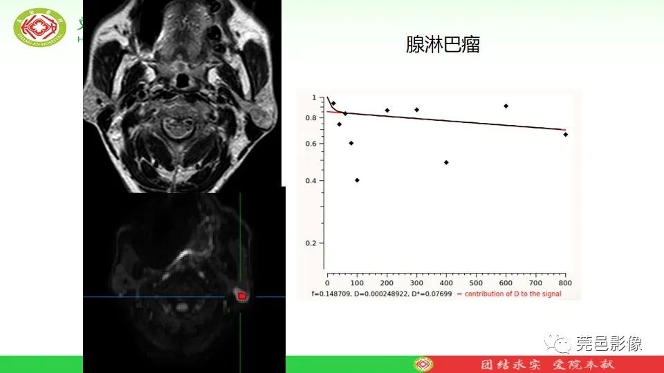 影像PPT - 【PPT】MRI征象在腮腺占位良恶性鉴别中的应用-74