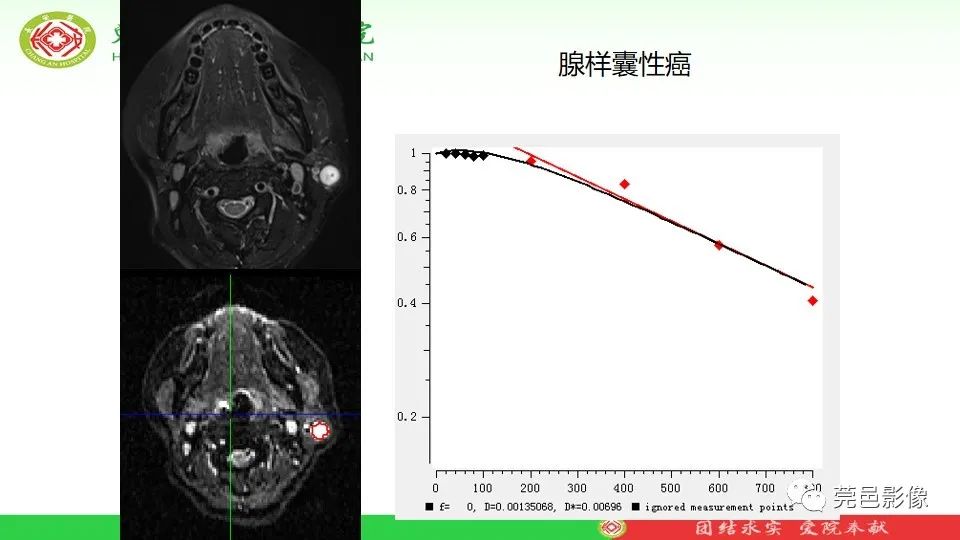 影像PPT - 【PPT】MRI征象在腮腺占位良恶性鉴别中的应用-76