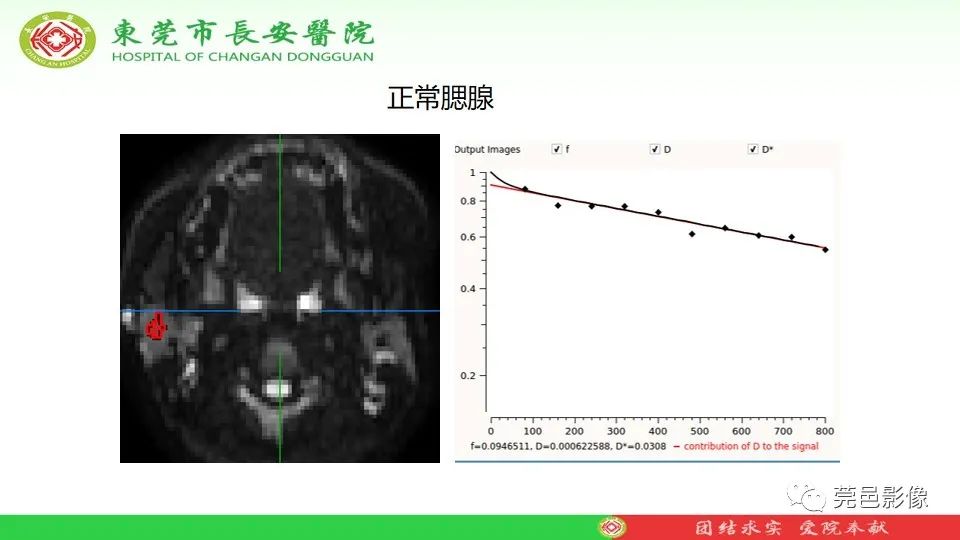 影像PPT - 【PPT】MRI征象在腮腺占位良恶性鉴别中的应用-72
