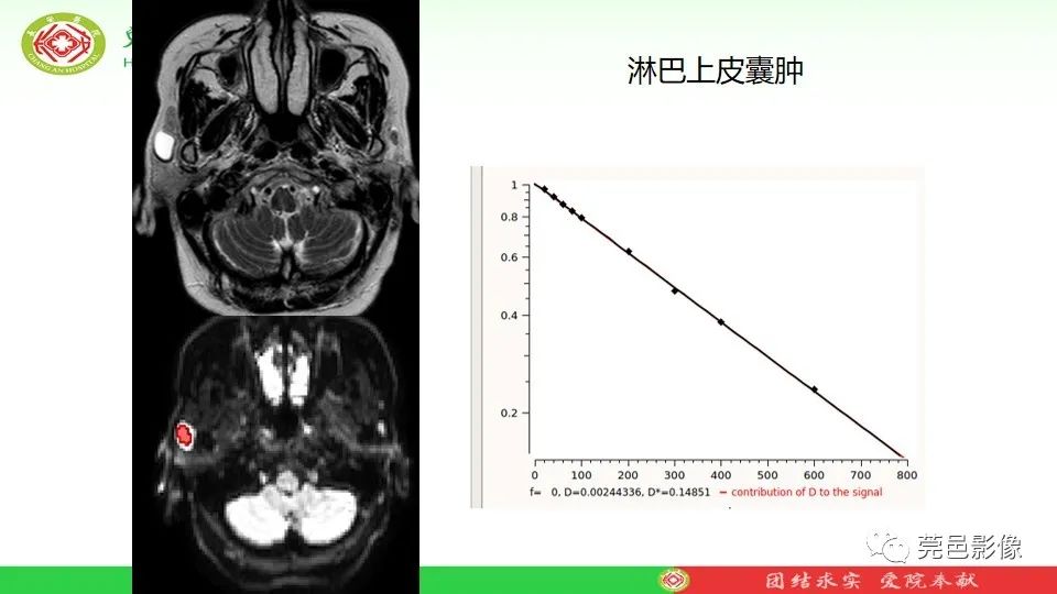 影像PPT - 【PPT】MRI征象在腮腺占位良恶性鉴别中的应用-75