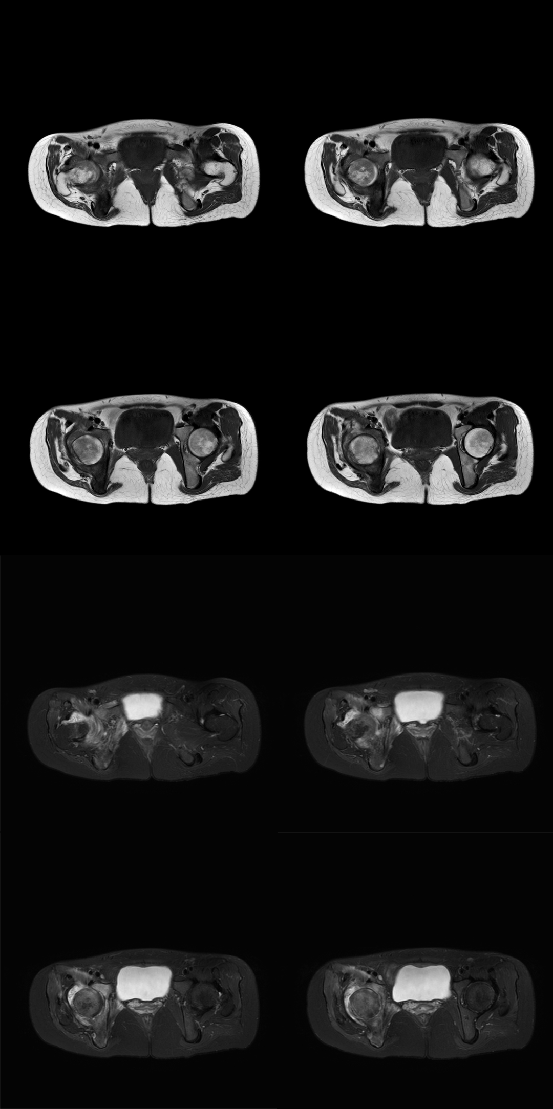 影像PPT - 【病例】少见部位典型表现,这样的类风湿性关节炎你见过吗?-5 影像PPT - 【病例】少见部位典型表现,这样的类风湿性关节炎你见过吗?-5