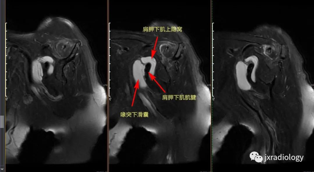 影像PPT - 如何区分肩胛下肌上隐窝积液和喙突下滑囊积液-4 影像PPT - 如何区分肩胛下肌上隐窝积液和喙突下滑囊积液-4