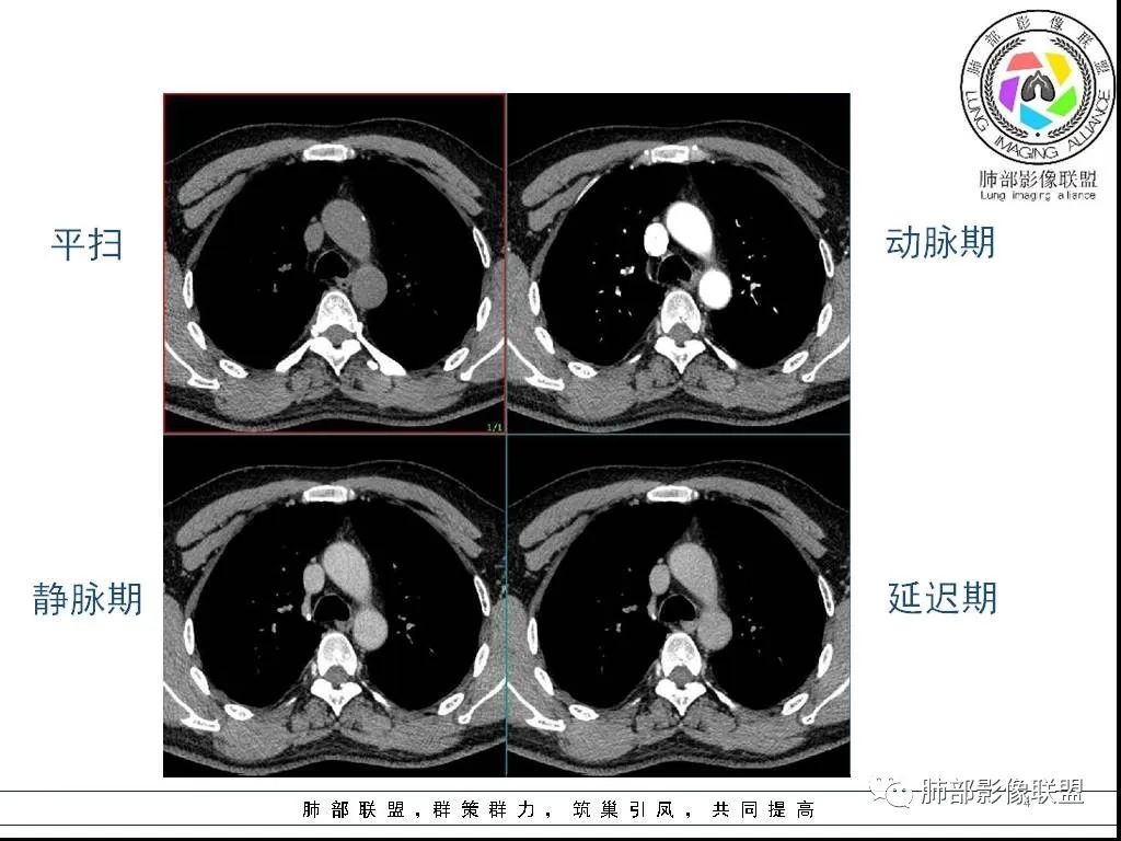 影像PPT - 【病例】前纵隔囊性肿物1例-4 影像PPT - 【病例】前纵隔囊性肿物1例-4