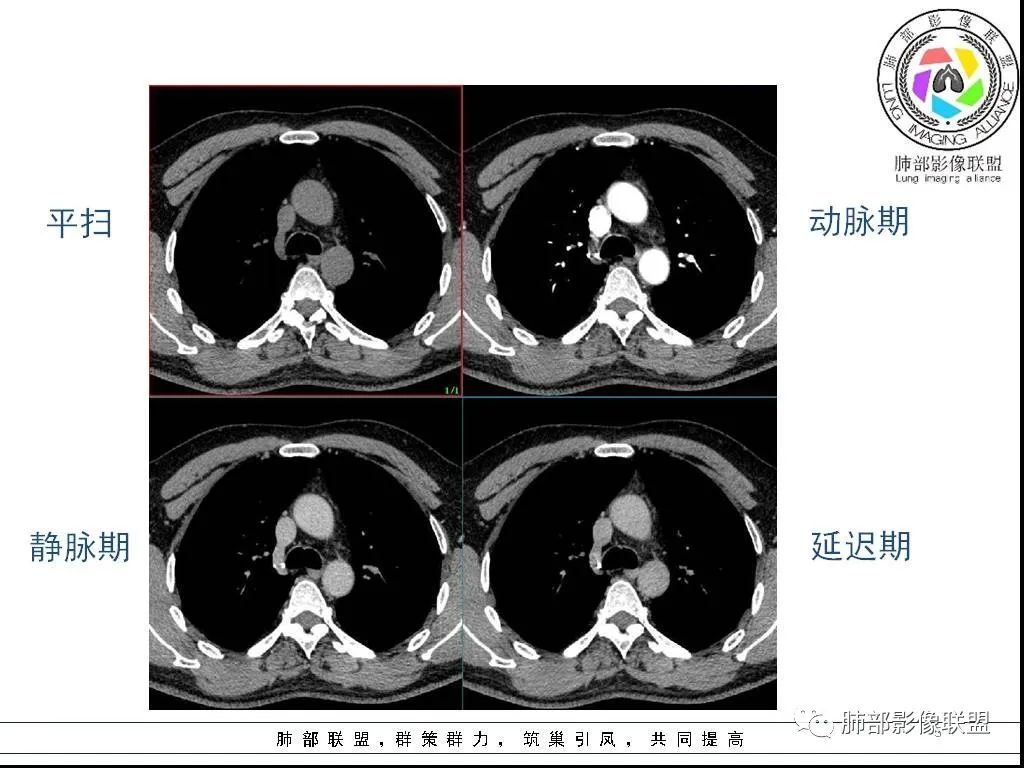 影像PPT - 【病例】前纵隔囊性肿物1例-5 影像PPT - 【病例】前纵隔囊性肿物1例-5