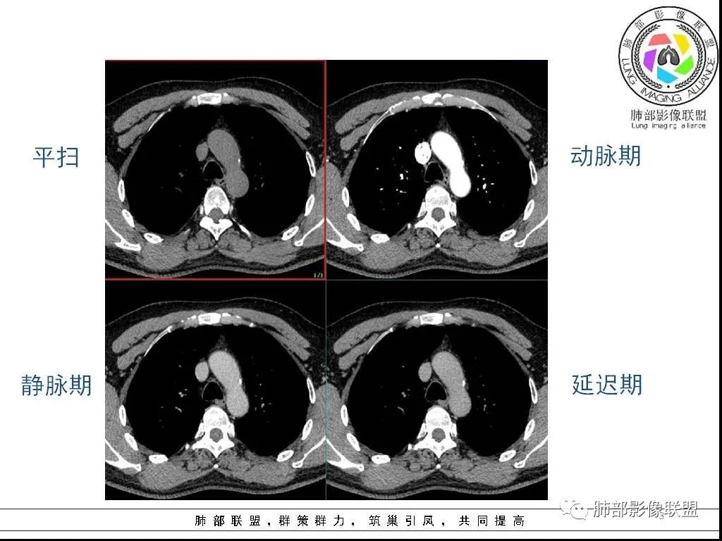 影像PPT - 【病例】前纵隔囊性肿物1例-3 影像PPT - 【病例】前纵隔囊性肿物1例-3