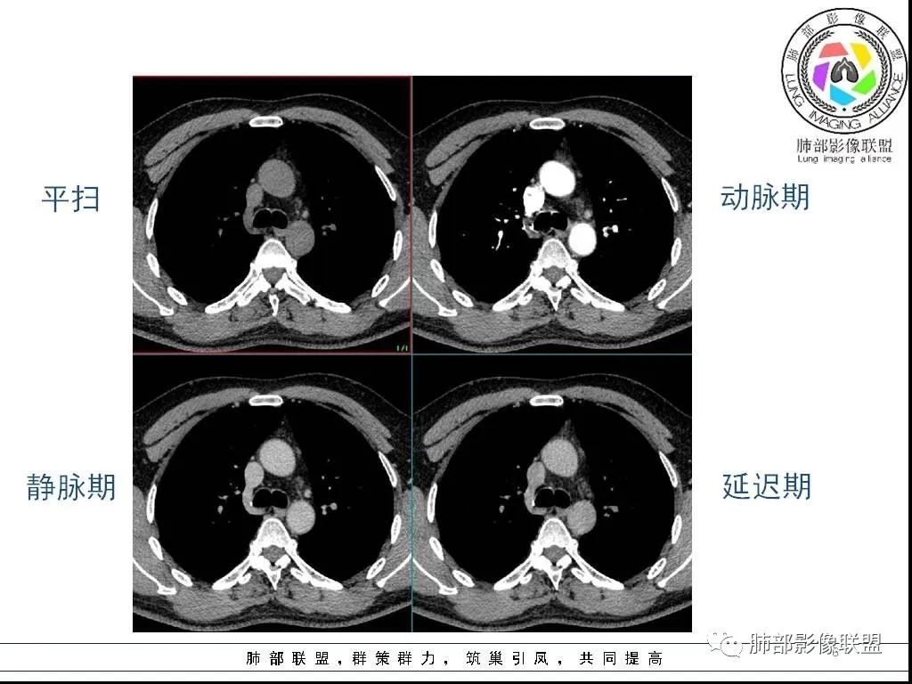 影像PPT - 【病例】前纵隔囊性肿物1例-6 影像PPT - 【病例】前纵隔囊性肿物1例-6