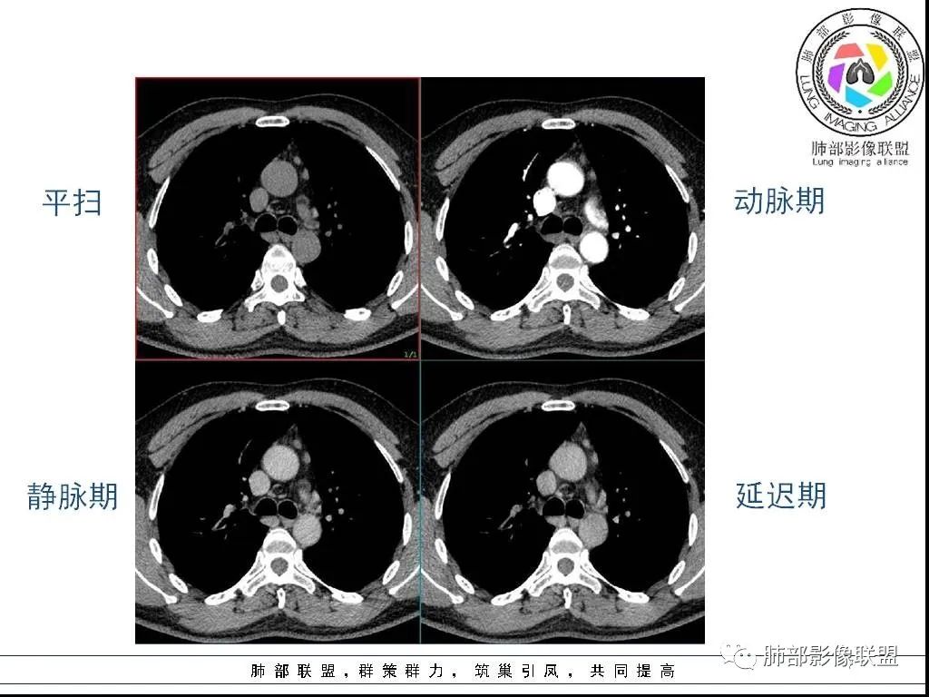 影像PPT - 【病例】前纵隔囊性肿物1例-7 影像PPT - 【病例】前纵隔囊性肿物1例-7