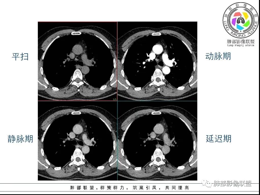 影像PPT - 【病例】前纵隔囊性肿物1例-9 影像PPT - 【病例】前纵隔囊性肿物1例-9