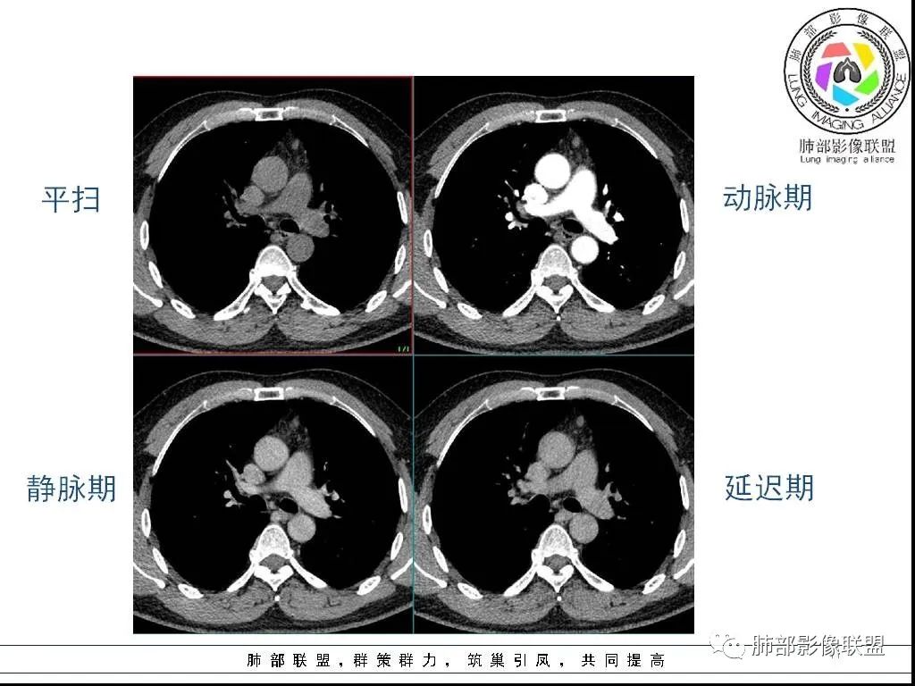 影像PPT - 【病例】前纵隔囊性肿物1例-11 影像PPT - 【病例】前纵隔囊性肿物1例-11