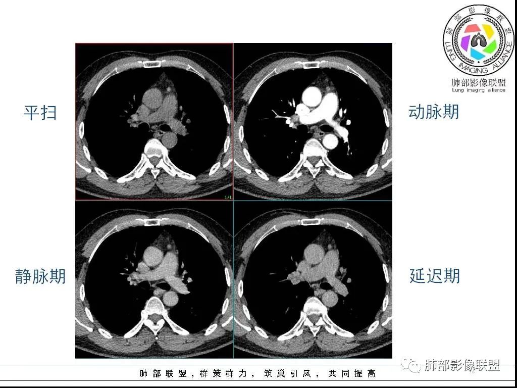 影像PPT - 【病例】前纵隔囊性肿物1例-12 影像PPT - 【病例】前纵隔囊性肿物1例-12