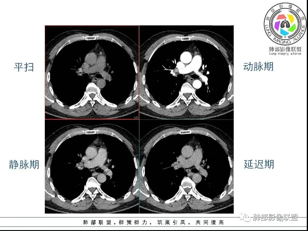 影像PPT - 【病例】前纵隔囊性肿物1例-13 影像PPT - 【病例】前纵隔囊性肿物1例-13