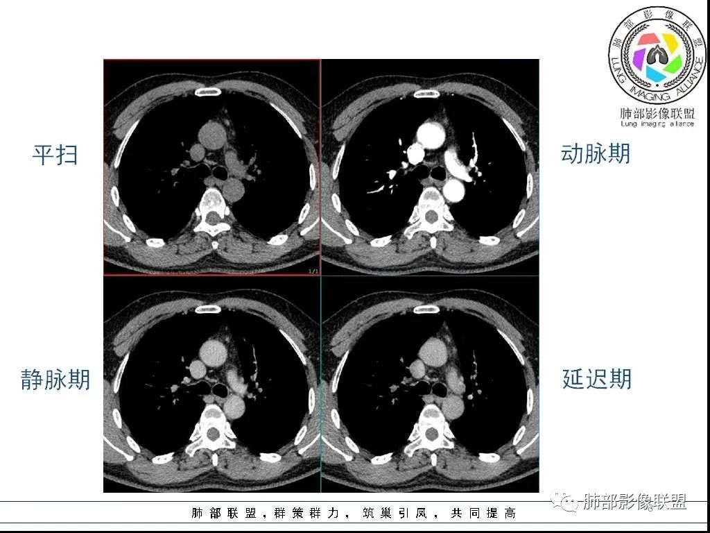 影像PPT - 【病例】前纵隔囊性肿物1例-8 影像PPT - 【病例】前纵隔囊性肿物1例-8