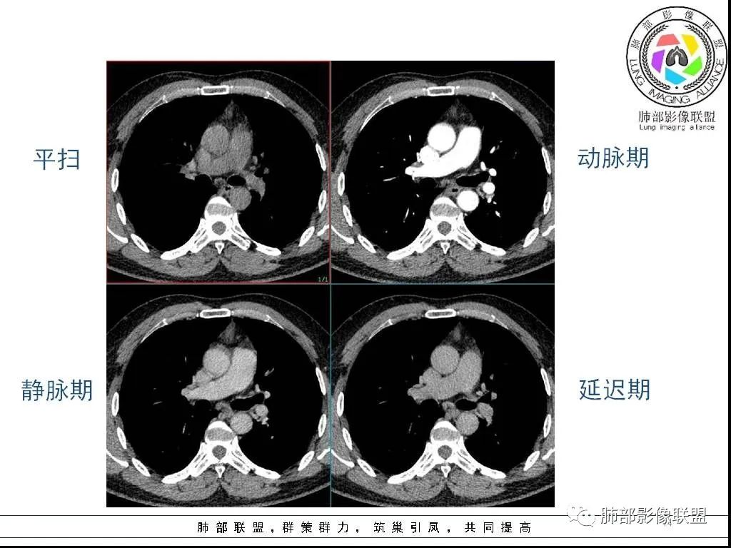 影像PPT - 【病例】前纵隔囊性肿物1例-14 影像PPT - 【病例】前纵隔囊性肿物1例-14
