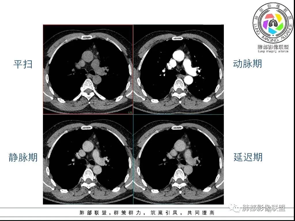 影像PPT - 【病例】前纵隔囊性肿物1例-10 影像PPT - 【病例】前纵隔囊性肿物1例-10
