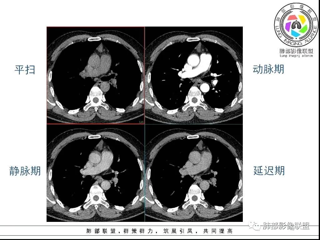 影像PPT - 【病例】前纵隔囊性肿物1例-16 影像PPT - 【病例】前纵隔囊性肿物1例-16