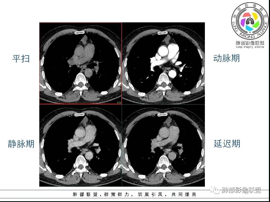 影像PPT - 【病例】前纵隔囊性肿物1例-18 影像PPT - 【病例】前纵隔囊性肿物1例-18