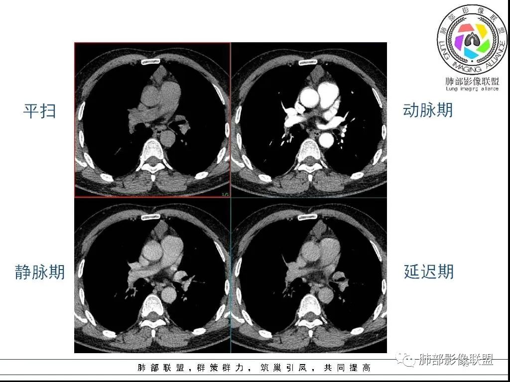 影像PPT - 【病例】前纵隔囊性肿物1例-19 影像PPT - 【病例】前纵隔囊性肿物1例-19