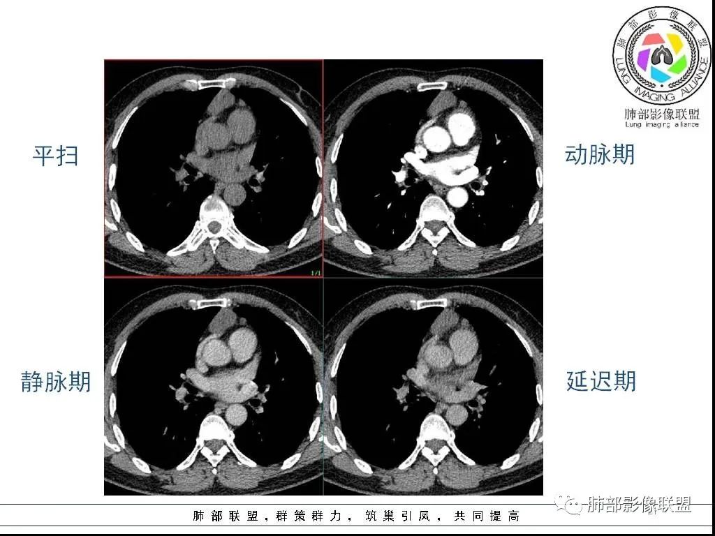 影像PPT - 【病例】前纵隔囊性肿物1例-21 影像PPT - 【病例】前纵隔囊性肿物1例-21