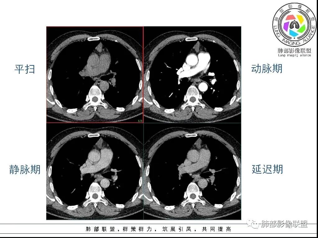 影像PPT - 【病例】前纵隔囊性肿物1例-17 影像PPT - 【病例】前纵隔囊性肿物1例-17
