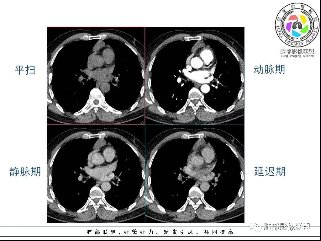 影像PPT - 【病例】前纵隔囊性肿物1例-22 影像PPT - 【病例】前纵隔囊性肿物1例-22