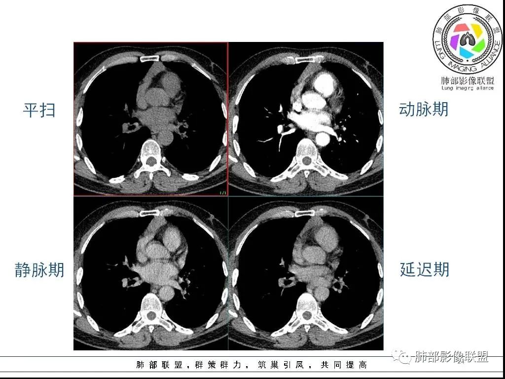 影像PPT - 【病例】前纵隔囊性肿物1例-24 影像PPT - 【病例】前纵隔囊性肿物1例-24