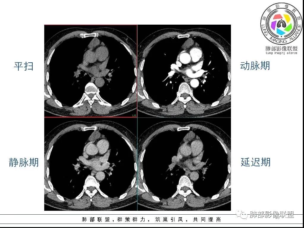 影像PPT - 【病例】前纵隔囊性肿物1例-20 影像PPT - 【病例】前纵隔囊性肿物1例-20