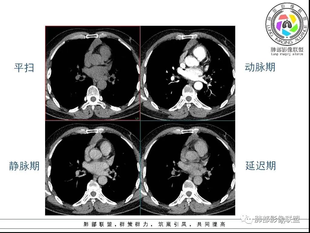 影像PPT - 【病例】前纵隔囊性肿物1例-23 影像PPT - 【病例】前纵隔囊性肿物1例-23