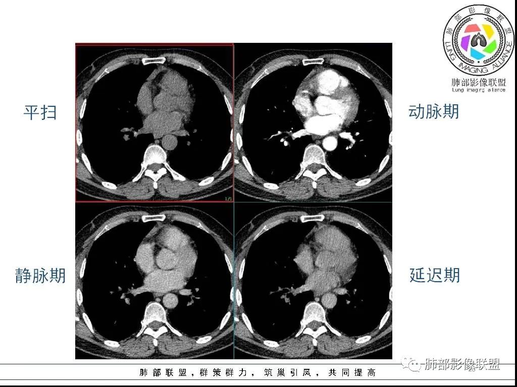 影像PPT - 【病例】前纵隔囊性肿物1例-28 影像PPT - 【病例】前纵隔囊性肿物1例-28