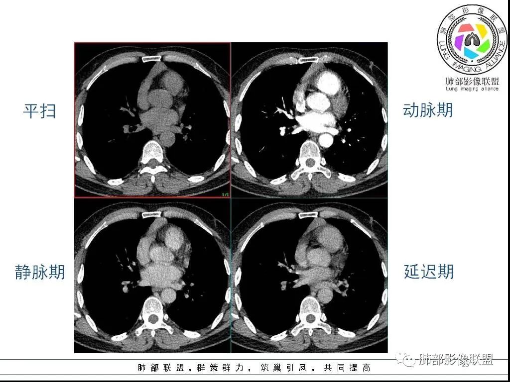 影像PPT - 【病例】前纵隔囊性肿物1例-25 影像PPT - 【病例】前纵隔囊性肿物1例-25