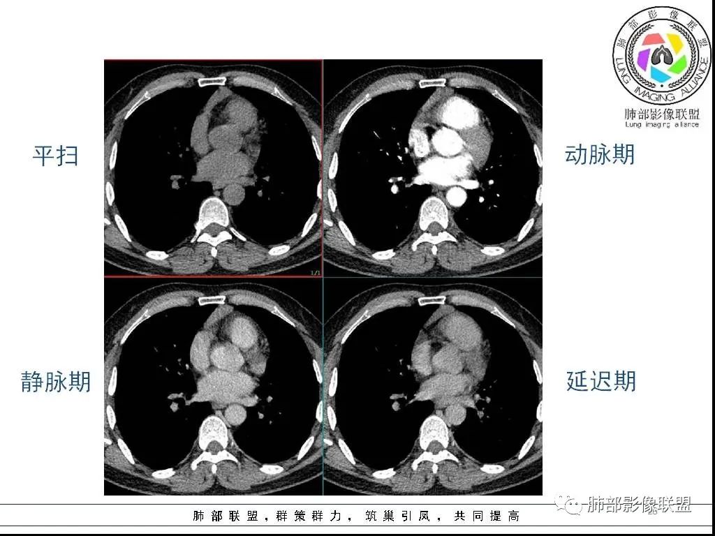 影像PPT - 【病例】前纵隔囊性肿物1例-26 影像PPT - 【病例】前纵隔囊性肿物1例-26