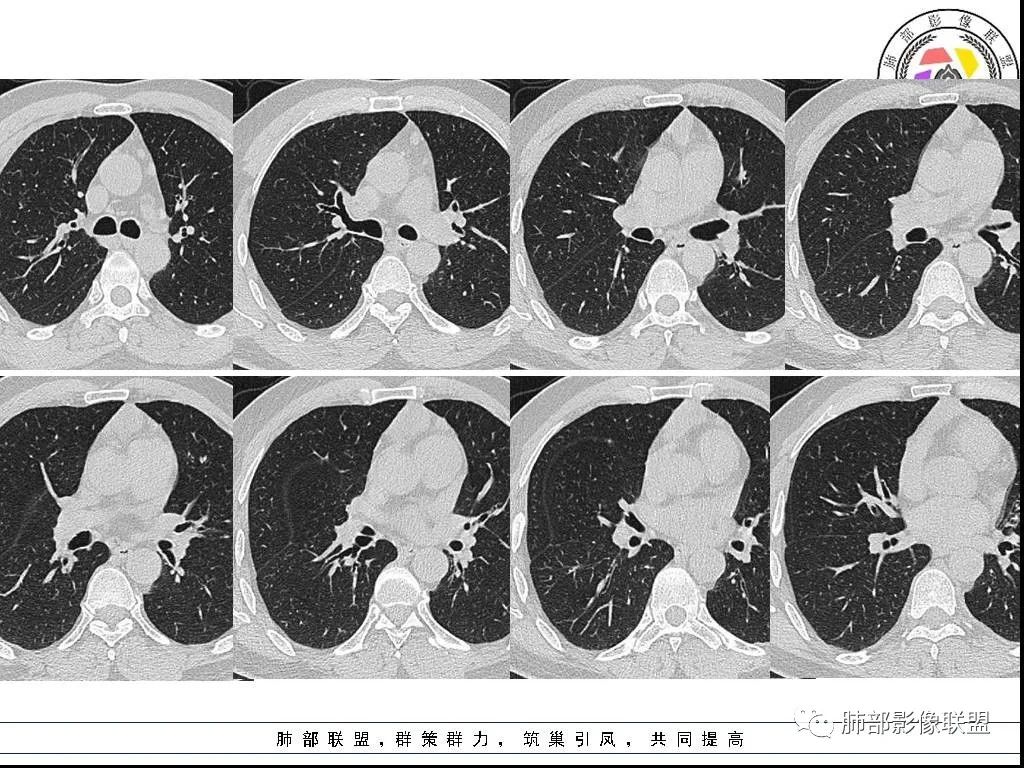 影像PPT - 【病例】前纵隔囊性肿物1例-30 影像PPT - 【病例】前纵隔囊性肿物1例-30