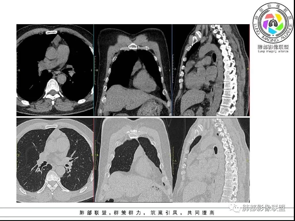 影像PPT - 【病例】前纵隔囊性肿物1例-31 影像PPT - 【病例】前纵隔囊性肿物1例-31